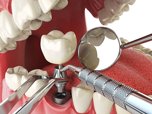 Best Emergency Root Canal Treatment in Montpelier, ID